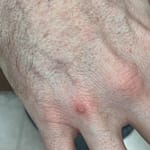 Pustular lesion on the right hand