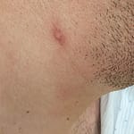 Resolving pustule on neck 1 of 3