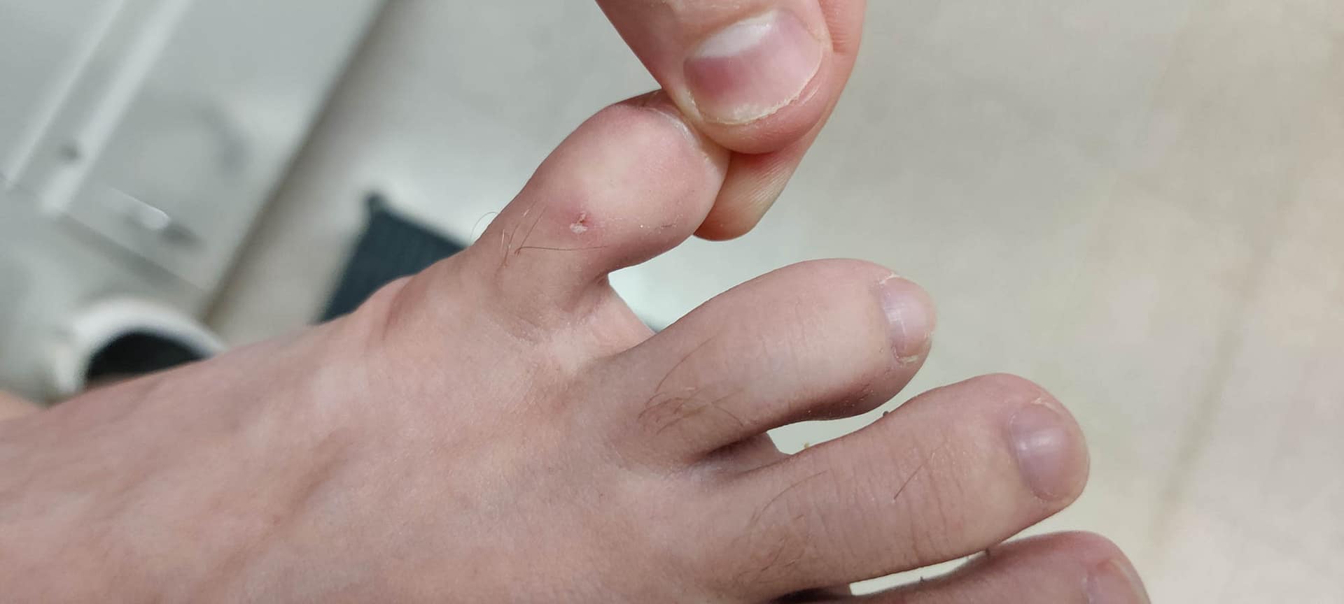 Small healing shallow ulcer on the dorsum of the toe 1 of 3