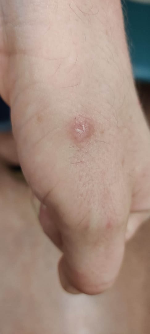 Healing ulcerative lesion on the left hand 2 of 2