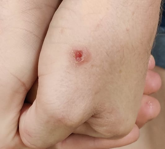Healing ulcerative lesion on the left hand.