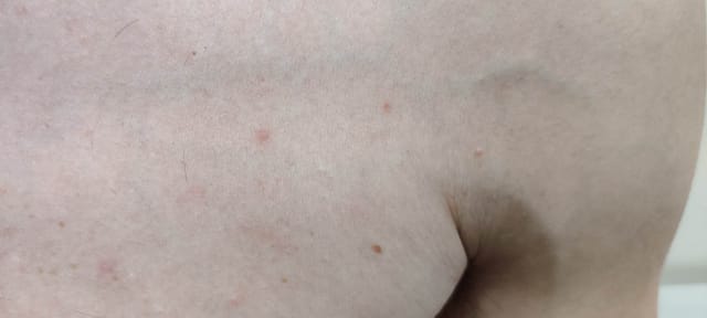 Small (1-2mm) maculopapular lesions on the back.