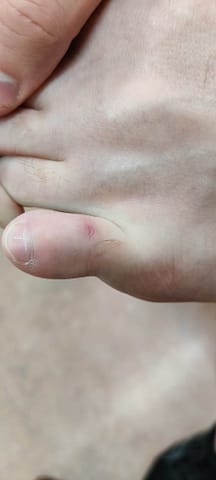 Resolved shallow ulcer on the dorsum of the toe.