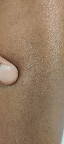 Pinpoint pustule on the arm.