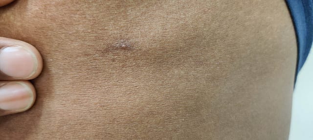 Pinpoint pustule on the thorax.