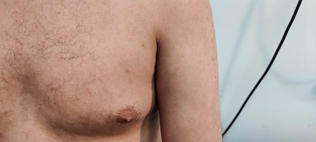 Pinpoint pustule on the chest.