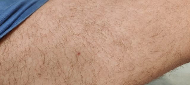 Pinpoint papule on the thigh.