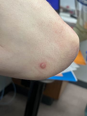 Vesicular lesion on the elbow.