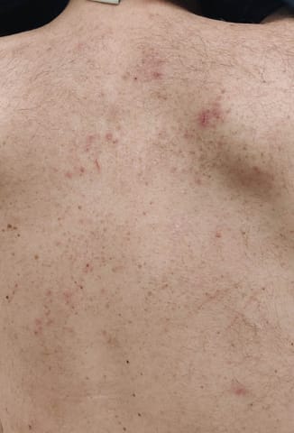Excoriated maculopapular lesions on the upper back.