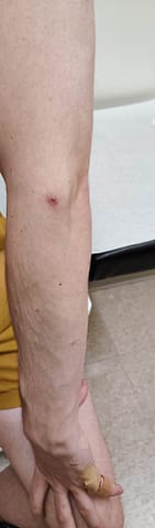 Partially scabbed ulcerated lesion on the arm.