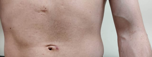 Papular lesions of varying sizes over the abdomen.