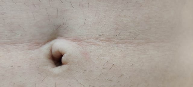 Healed skin at the site of a prior ulcerated papule on the abdomen.