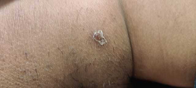 Healing buttock lesion.