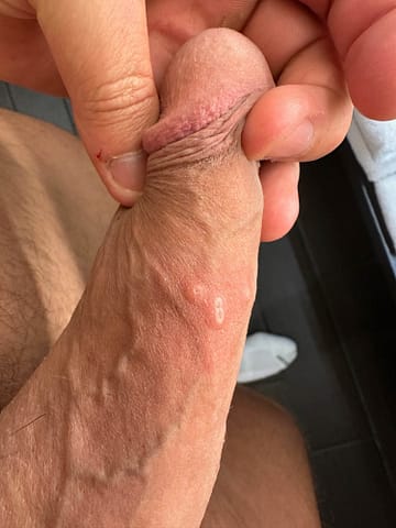Cluster of small umbilicated pustules with mild surrounding erythema on the shaft of the penis.