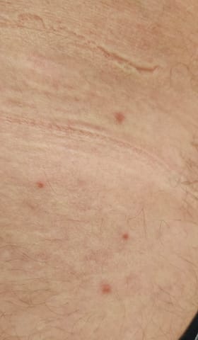 Small 2-3mm papules on the hip.
