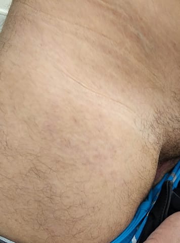 23-2 HEALED HIP 203012 20220714_175105-anon Healed skin with minimal residual hyperpigmentation at the site of former small papules on the upper leg.