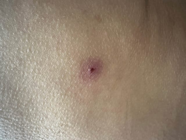 Partially scabbed ulcerative lesion on the buttock.