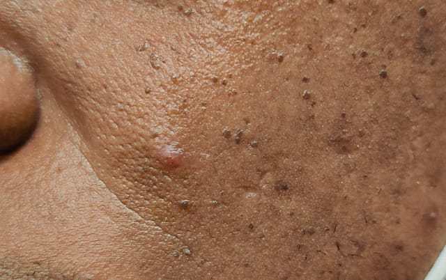 Papule on the cheek.
