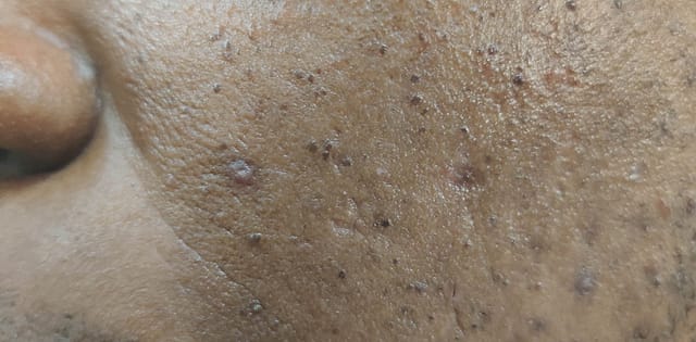 Healing ulcer on the cheek.