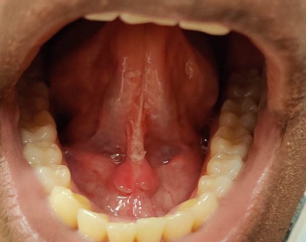 Ulcer on the frenulum of the tongue.