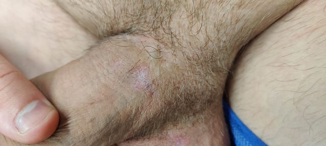 Fully healed genital ulcer.