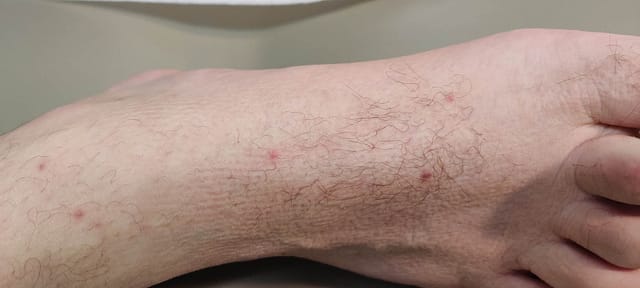 Erythematous papules on the foot.