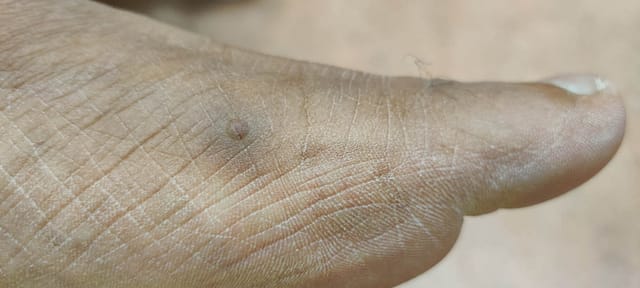 Hyperpigmented papule on the left foot.