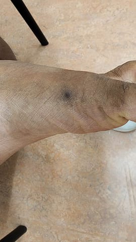 Scabbed papule on the left foot.