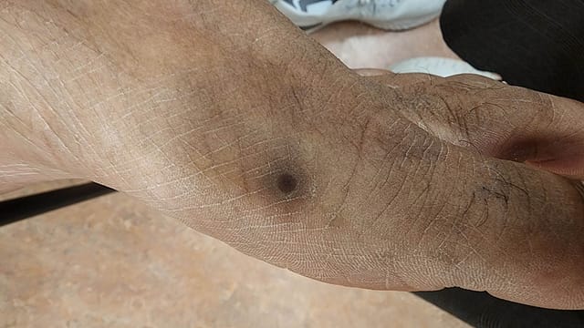 Scabbed papule on the left foot.