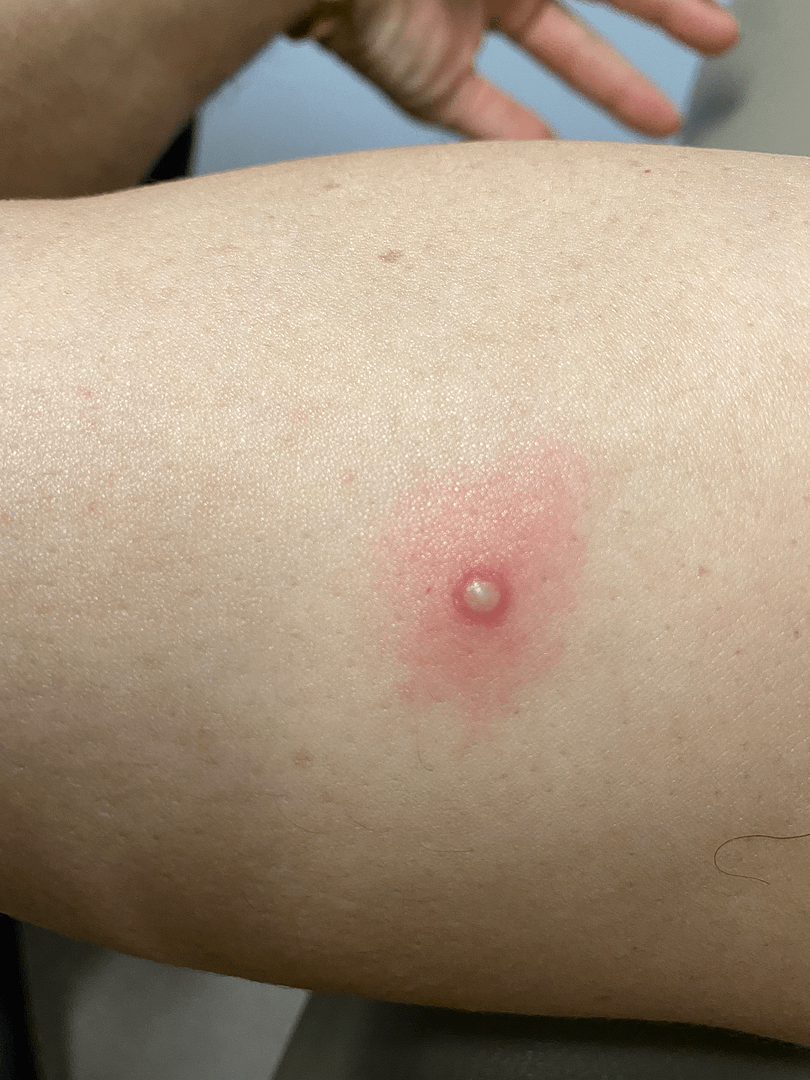 Vesiculopustular lesion on upper arm 2