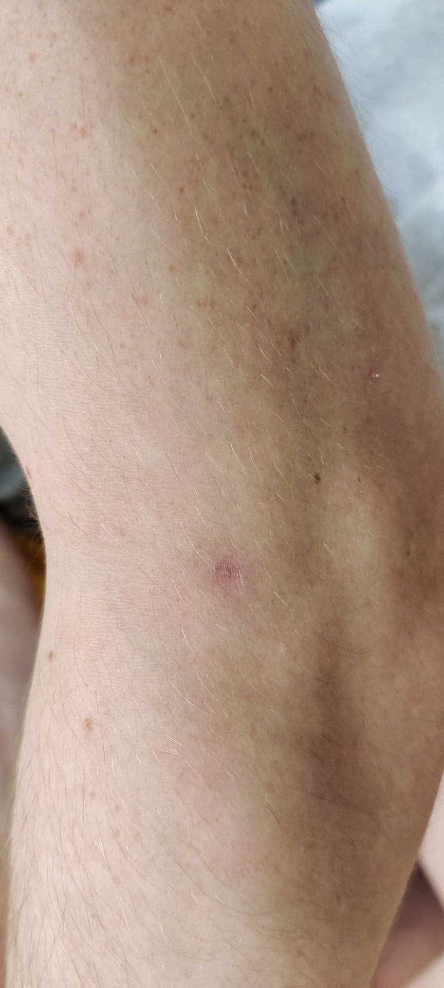 Healed skin at the site of a prior ulcerated lesion on the arm.