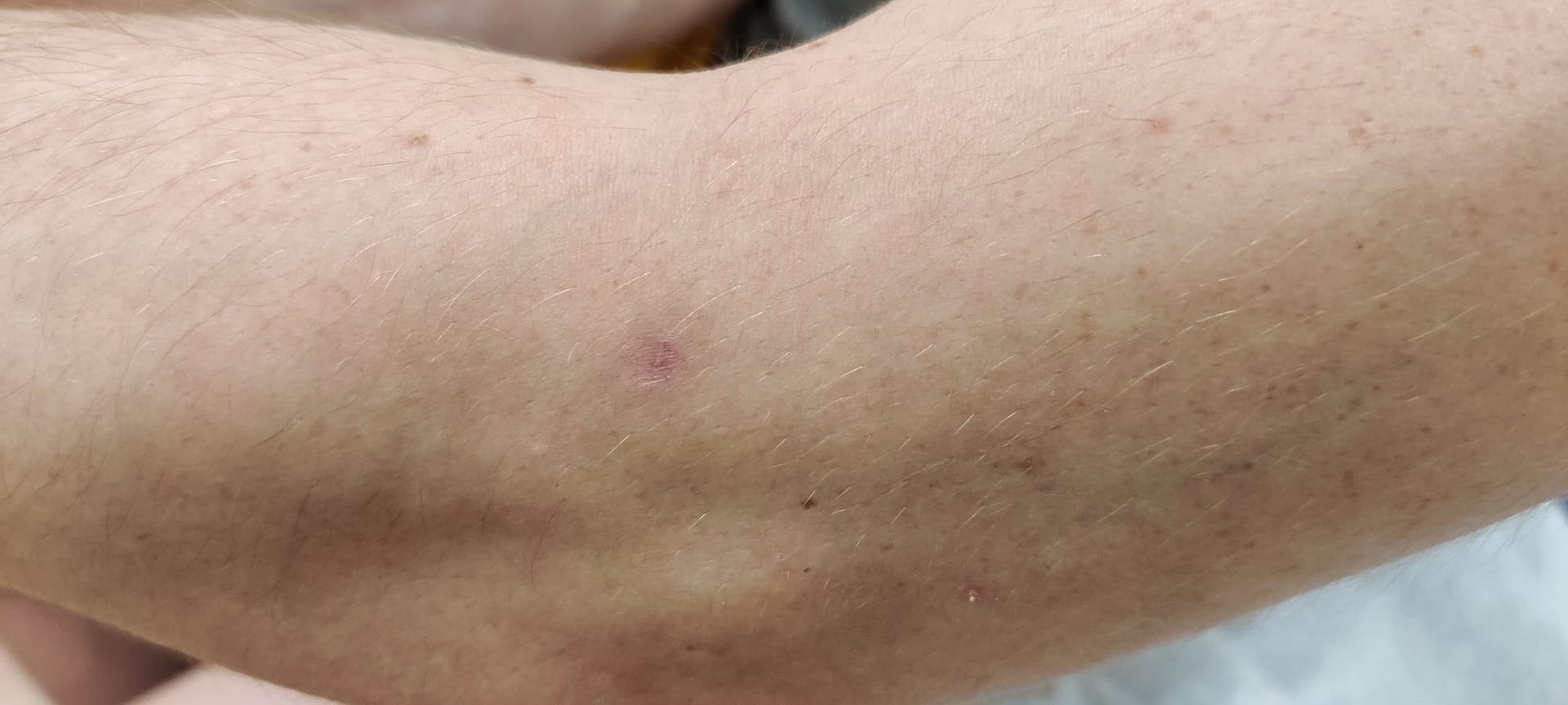 Healed skin at the site of a prior ulcerated lesion on the arm.